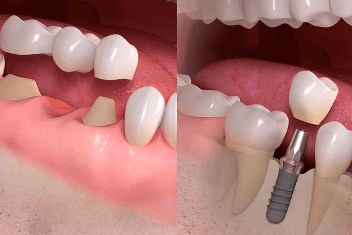 ponte e impianto dentale stefani