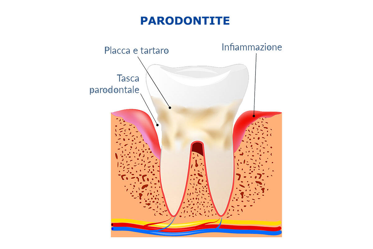 stefani-dentista-diabete-e-rischio-parodontite