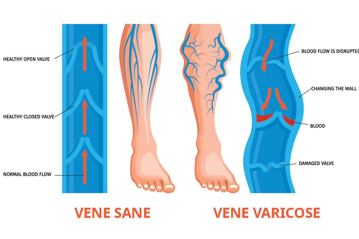 parisi-vene-sane-e-vene-varicose