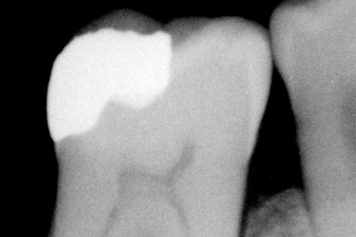 amalgama-mercurio-denti-nicolin