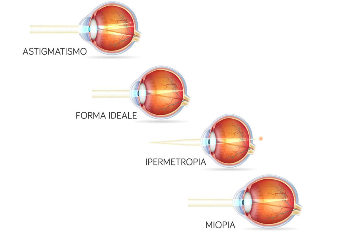 poggi-difetti-rifrazione-occhio