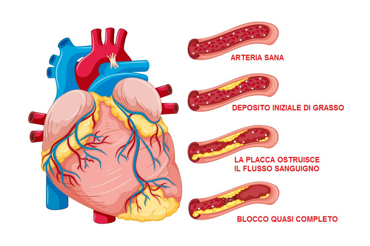 parisi-stato-salute-arterie-angiologo