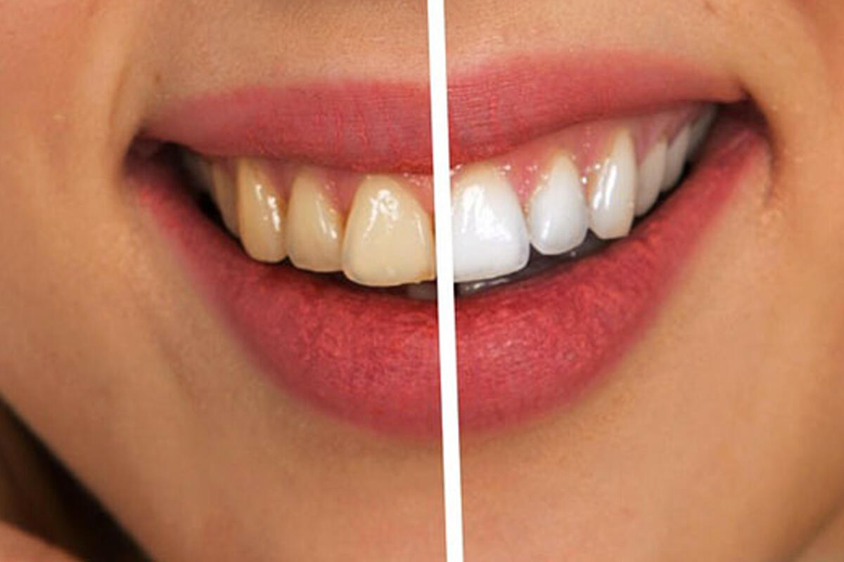 nicolin-denti-sani-e-ingialliti