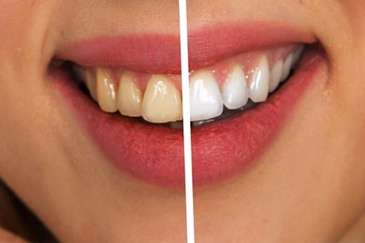 dal-carlo-sorrido-prima-e-dopo-sbiancamento