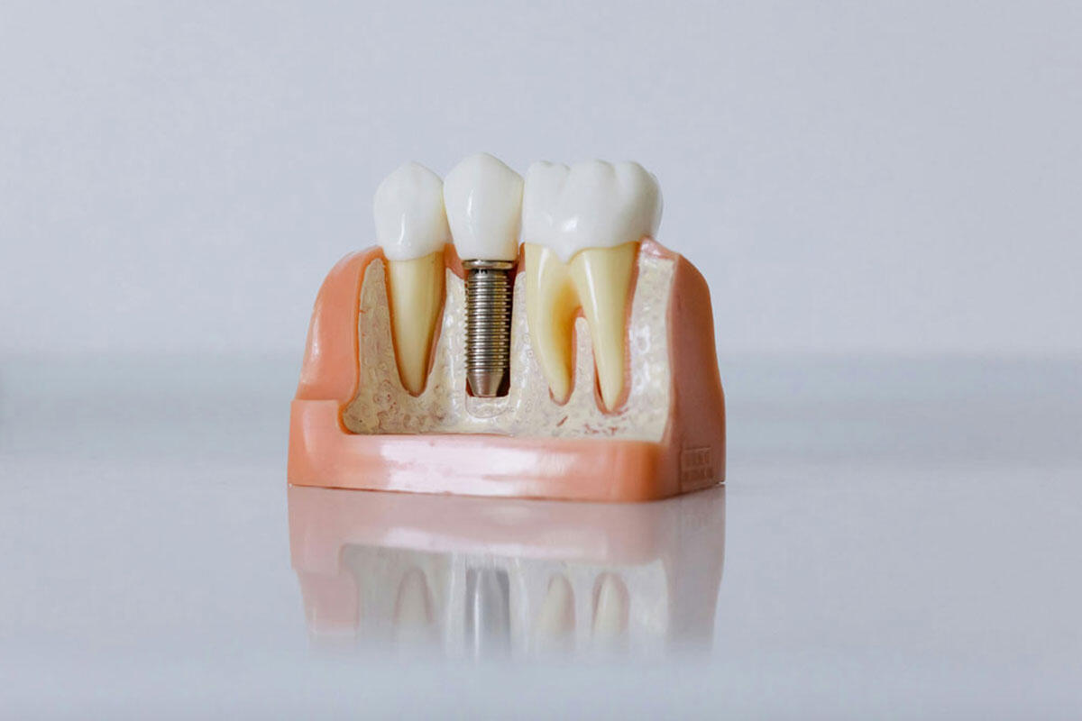 nicolin-impianti-dentali-anziani