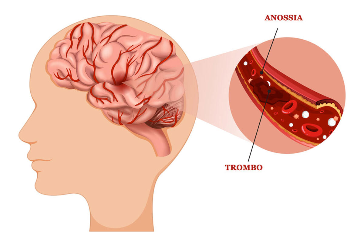 parisi-ictus-trombo-anossia