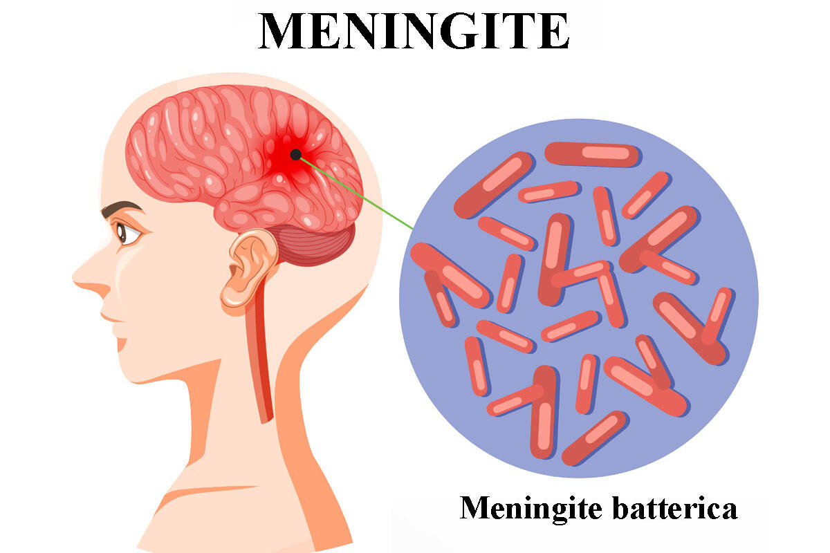 scassola-meningite-batterica
